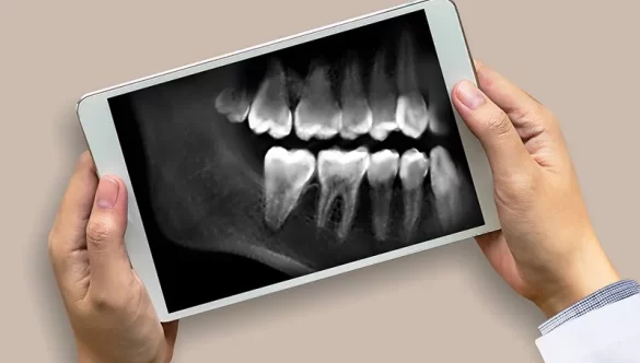 Exploring the Evolution and Efficacy of Dental X-rays