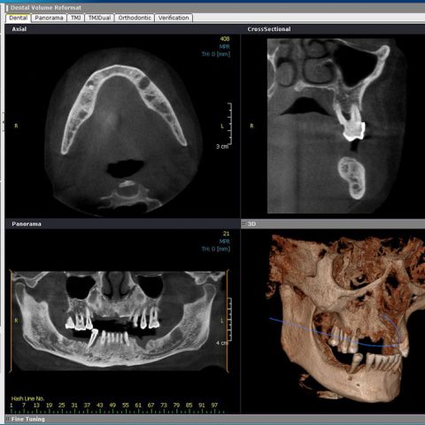 CBCT1