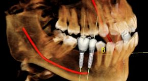 Implant-simulation