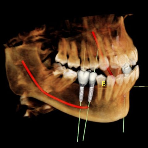 Implant-simulation